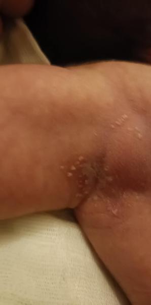 Sú to vyrážky alebo zaparenina?