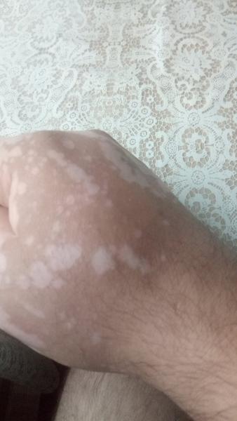 Biele fľaky na pokožke: