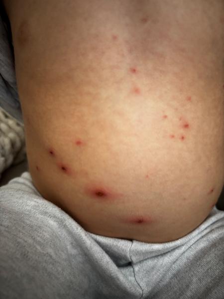 Priebeh kiahní u dvojročného dieťaťa