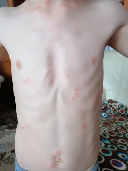 Má môj syn alergickú reakciu, alebo sú to štípance?