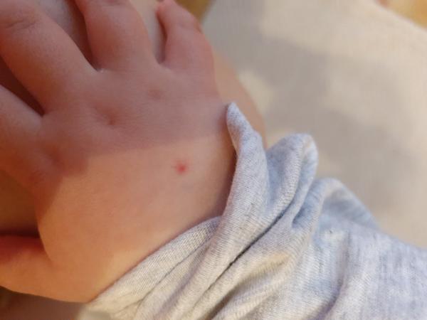Ako sa dá liečiť hemangióm na ruke trojročnej dcérky?