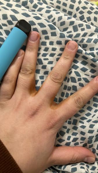 Čo spôsobuje hnedé fľaky medzi prstami?