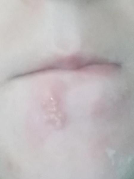 Čo na synove vyrážky?