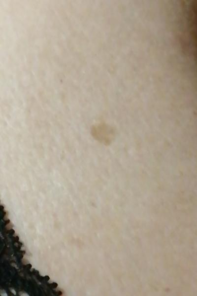 Čo môže spôsobovať vyrážky na koži?