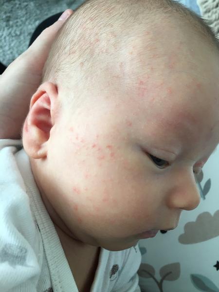 Vyrážky u 6 týždňového bábätka