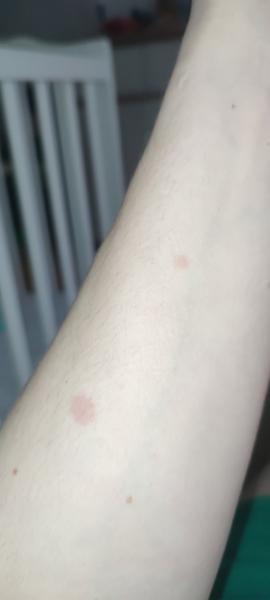 Z čoho sa mi mohli vytvoriť tieto fliačky na ruke?