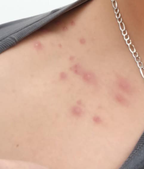 Vyrážky na dekolte