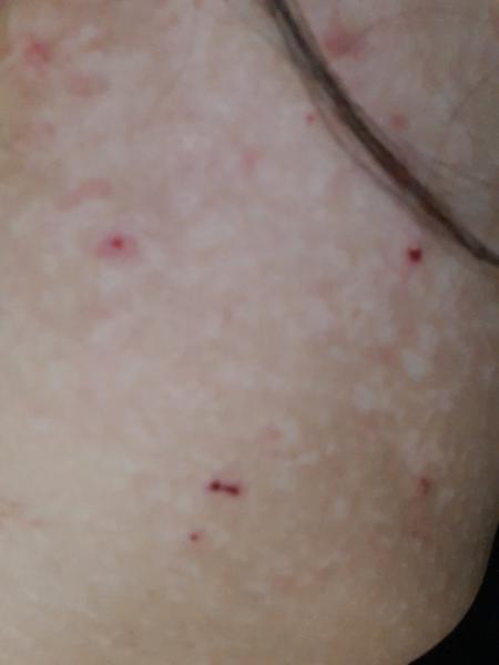 Biele škvrny na chrbte