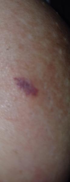 Prečo sa mi tvorí modrastá vyrážka na prsníku?