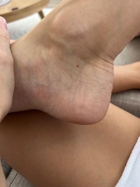 Ako predísť kôrnateniu ciev a metličkovým žilám?