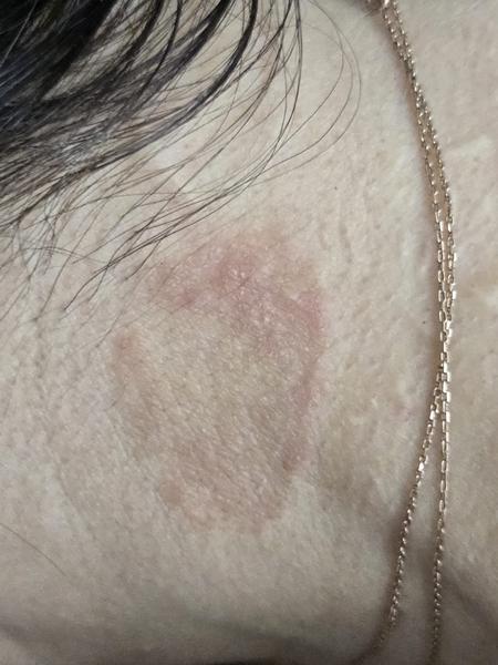 Je to pásový opar alebo niečo iné?