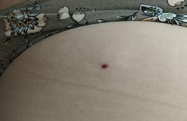 Fraxiparine - miesto vpichu