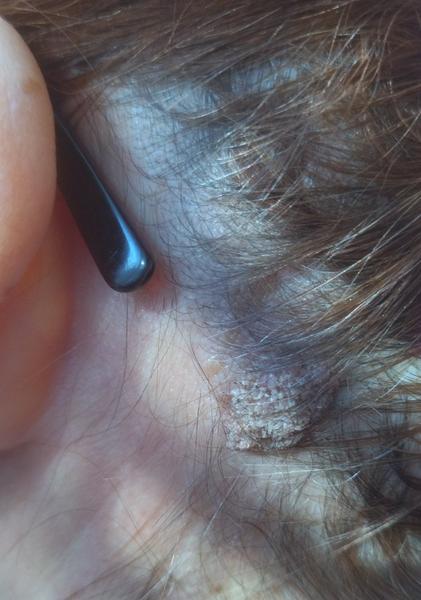 Skúsenosti s chrastou v hlave, ktorá svrbí