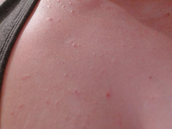 Akú to mám vyrážku?