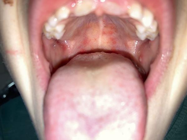 Z čoho sa synovi vytvorili fľaky a afty v hrdle?