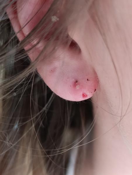 Zápal pod náušnicou