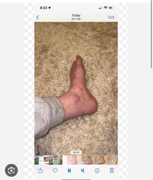 Je normálne mať takto prekrvené nohy?