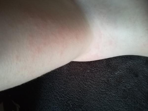 Šíriace sa vyrážky