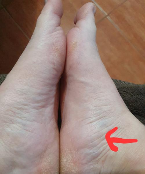 Môžem vylúčiť trombózu?