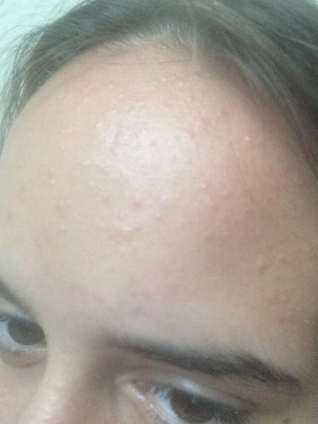 Neviem sa zbaviť kožného problému.