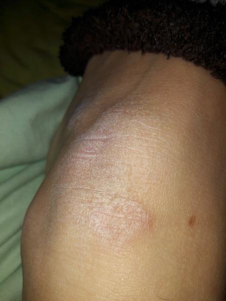 Vyrážky na kolenách