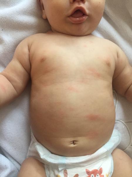 Fľaky na brušku po očkovaní