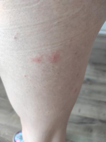 Spoznajte príčinu štípancov na nohe