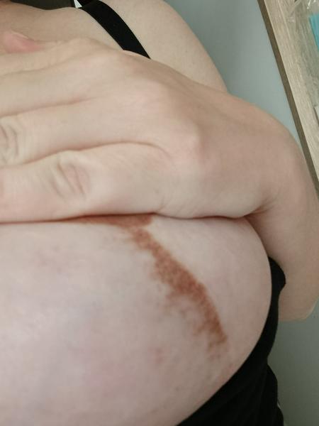 Čo môže byť príčinou pigmentácie v okolí jazvy po mastopexii?