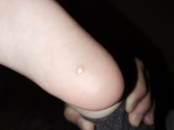 Výrastok na päte - čo to môže byť?