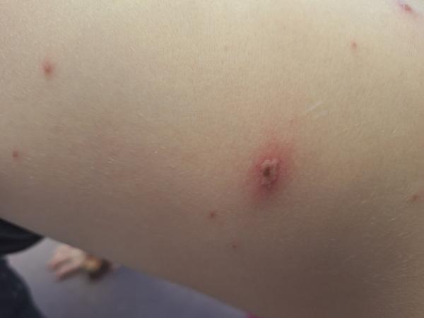 Je hojenie po kiahňach v poriadku?