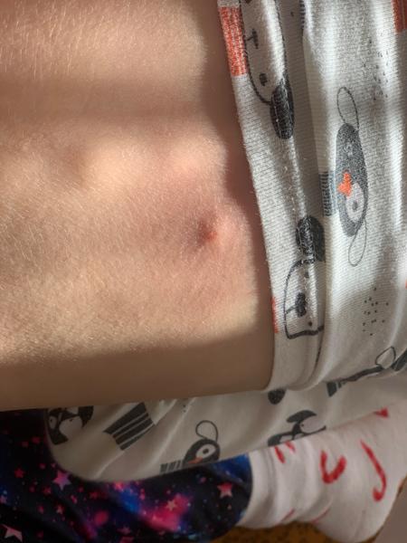 Je táto reakcia po vybratí kliešťa normálna?