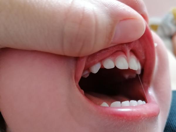 Má moja 19 mesačná dcérka kaz?