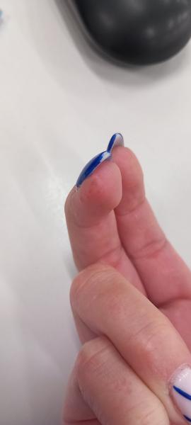 Kvôli čomu sa mi mohli vytvoriť vyrážky na prostredníku?