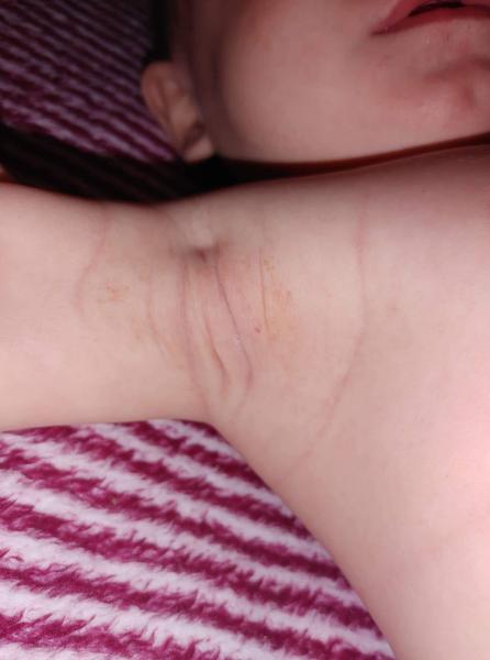 Aké fľaky pod pazuchou má môj 6-mesačný synček?