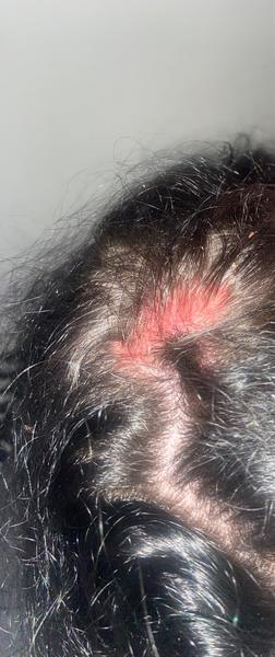 Má moja sestra atopický ekzém?