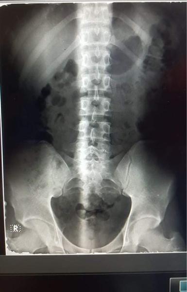 Ide o spinálnu stenózu?