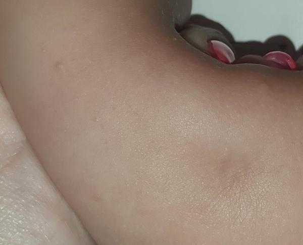 Týždeň mám vyrážky