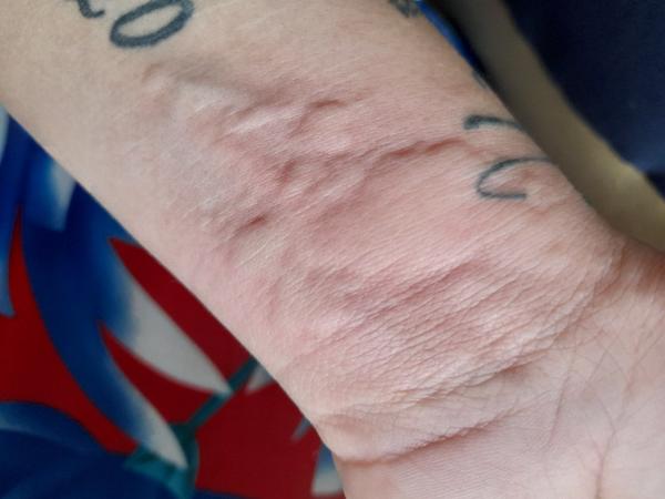 Doštípali ma ploštice?