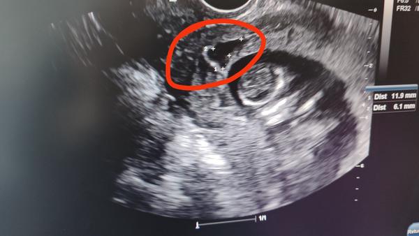 Čo môže byť neznámy útvar na sone?