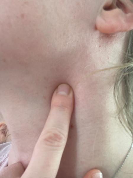 Čo mi odporúčate, keď mám 2 cm veľkú uzlinu?