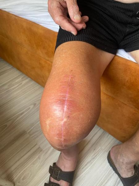 Otec je po operácii kolena a má červené okolo rany