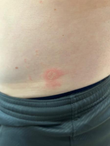 Čo sú to za vyrážky?