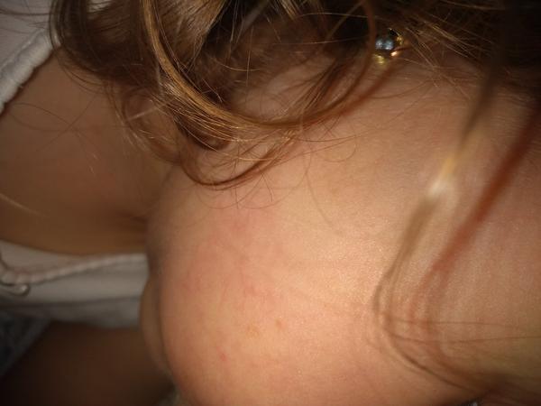 Žilky na lícach trojročnej dcérky