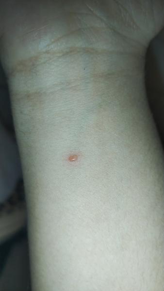 O akú vyrážku ide?