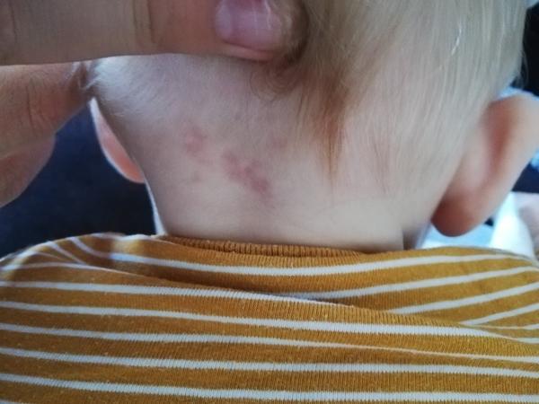 Aký kožný problém má môj 7 mesačný syn?