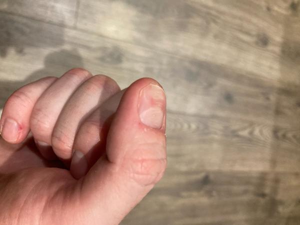 Mám zjazvený necht a poškodené lôžko