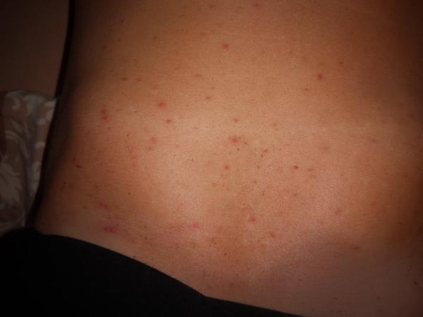 Kožné vyrážky na bruchu