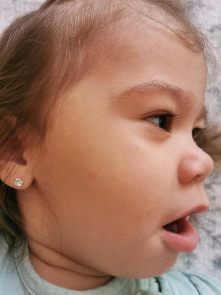 Môže mať dieťa vyrážky na tváričke zo zubov?