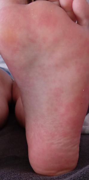 Môže mať dcérka alergickú reakciu na mandle?