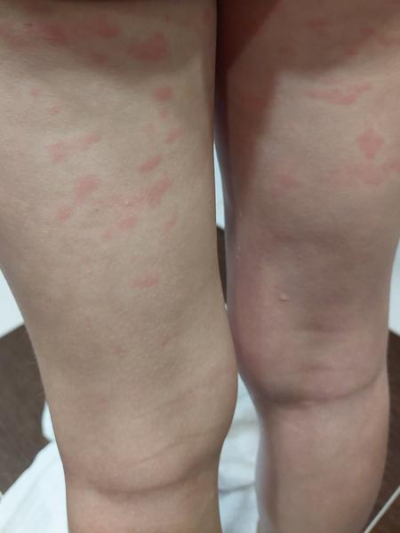 Môže tento vyrážkový prejav byť piata choroba?